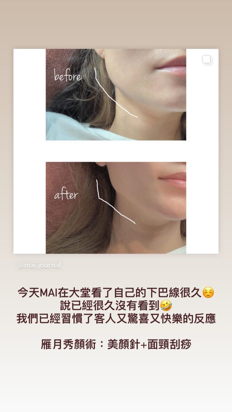 大J老婆Mia美顏針